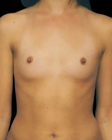 Breast Augmentation case #3620