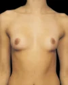 Breast Augmentation case #3625