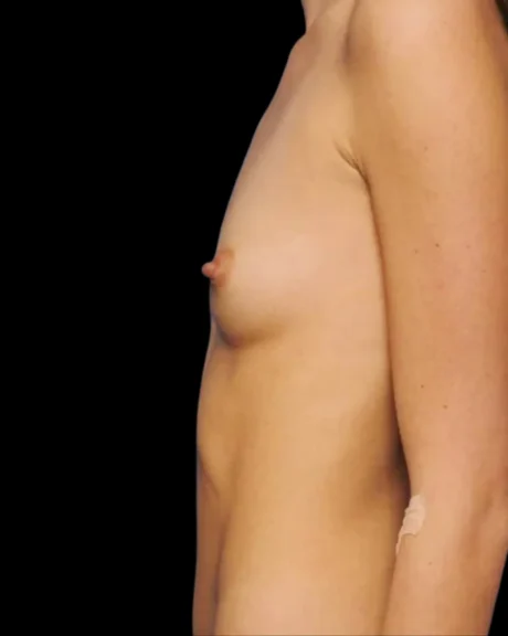 Breast Augmentation case #3631