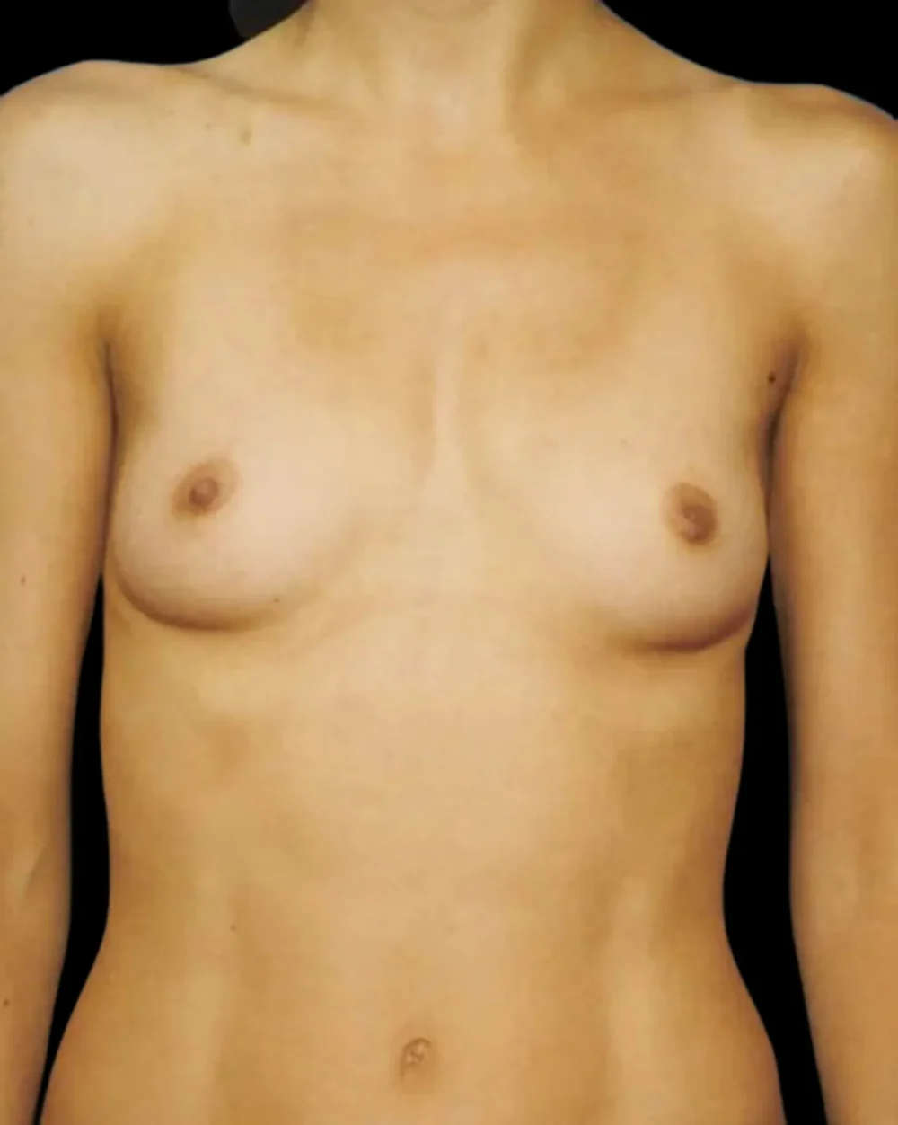 Breast Augmentation case #3636