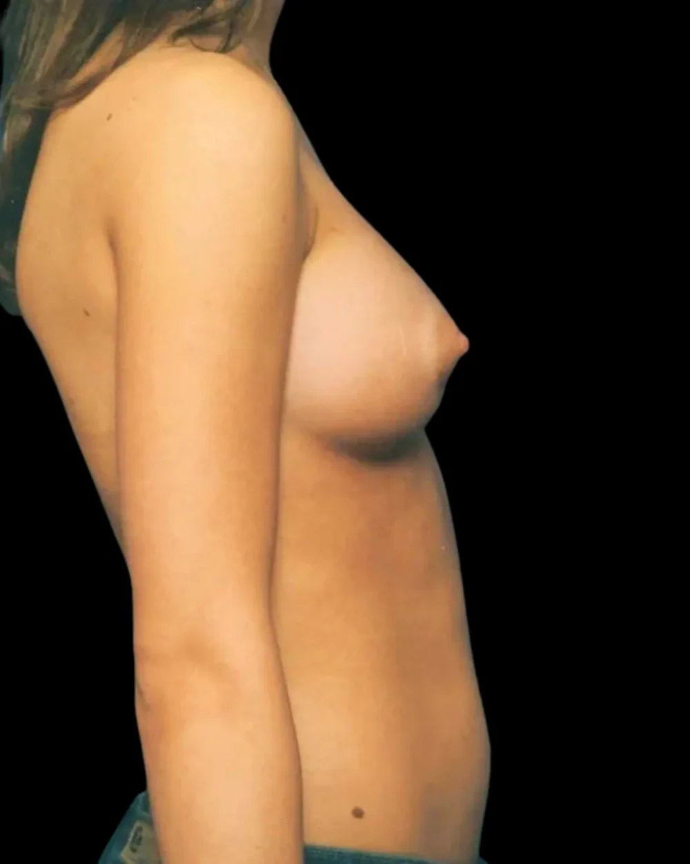 Breast Augmentation case #3653