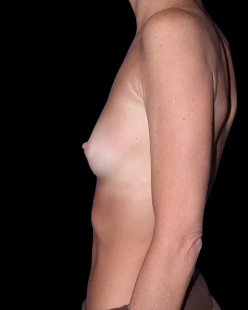 Breast Augmentation case #3670