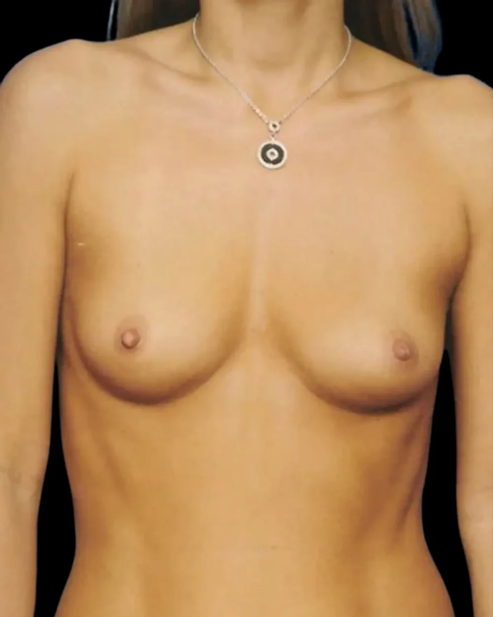 Breast Augmentation case #3675