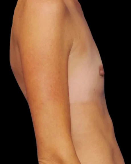 Breast Augmentation case #3680