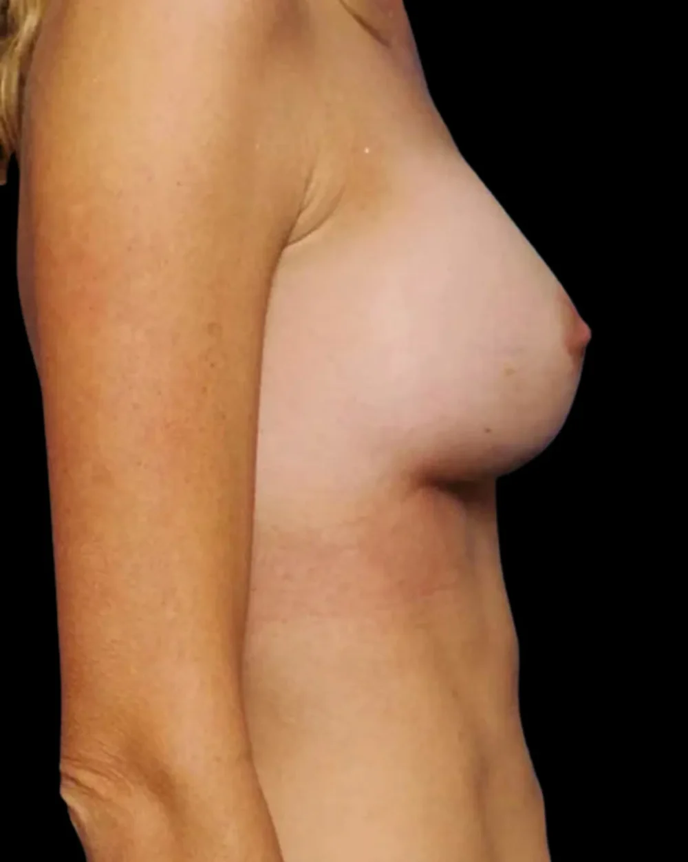 Breast Augmentation case #3680