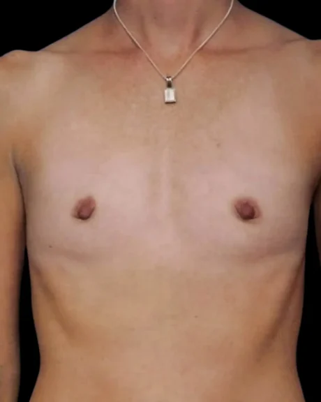 Breast Augmentation case #3680