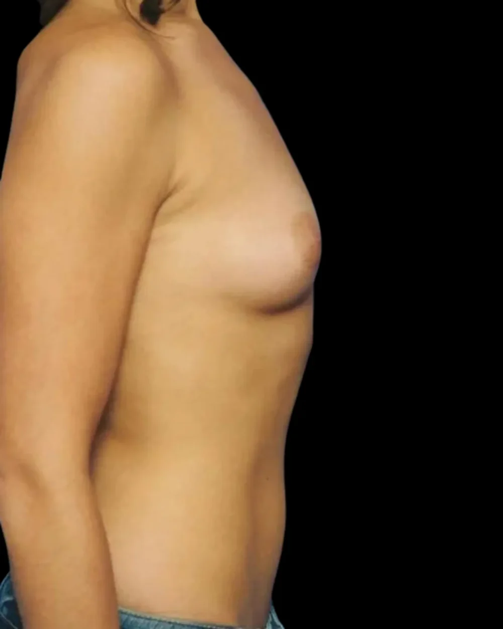 Breast Augmentation case #3685