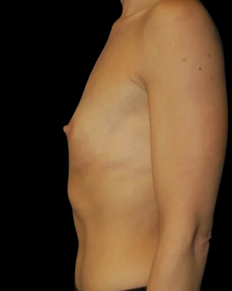 Breast Augmentation case #3697
