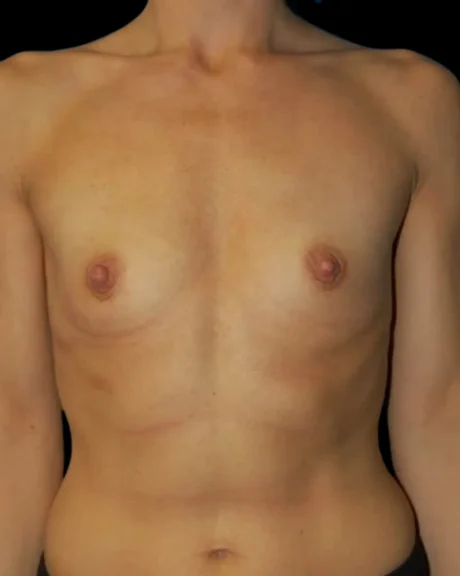 Breast Augmentation case #3697