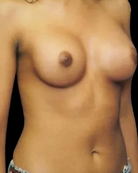 Breast Augmentation case #3754