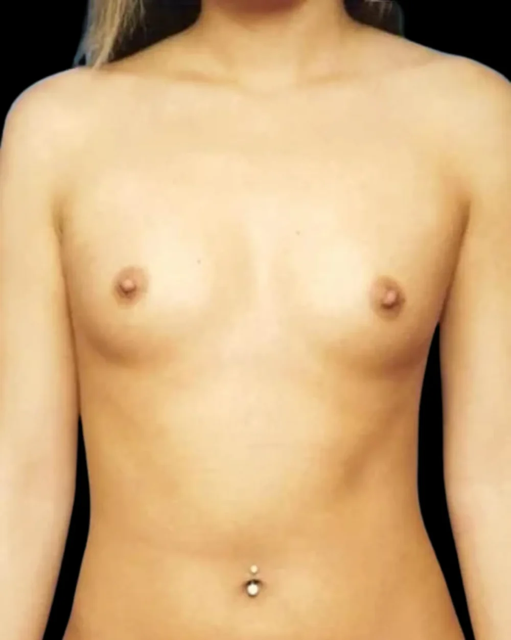 Breast Augmentation case #3777