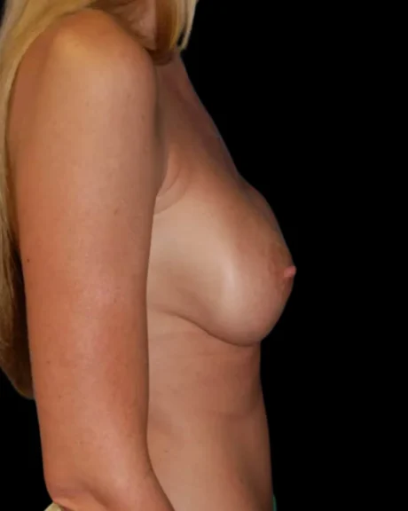 Breast Implant Revision case #3859