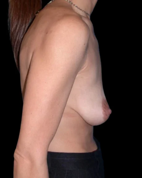 Breast Augmentation with Full Lift case #3919