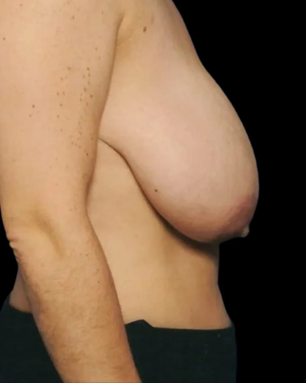 Breast Lift case #3968