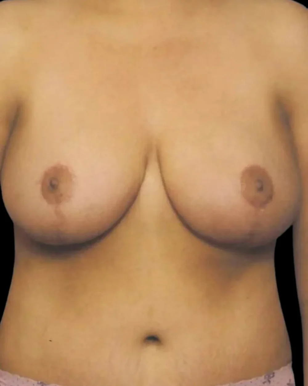 Breast Lift case #3982
