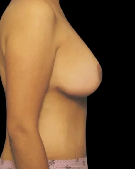 Breast Lift case #3982