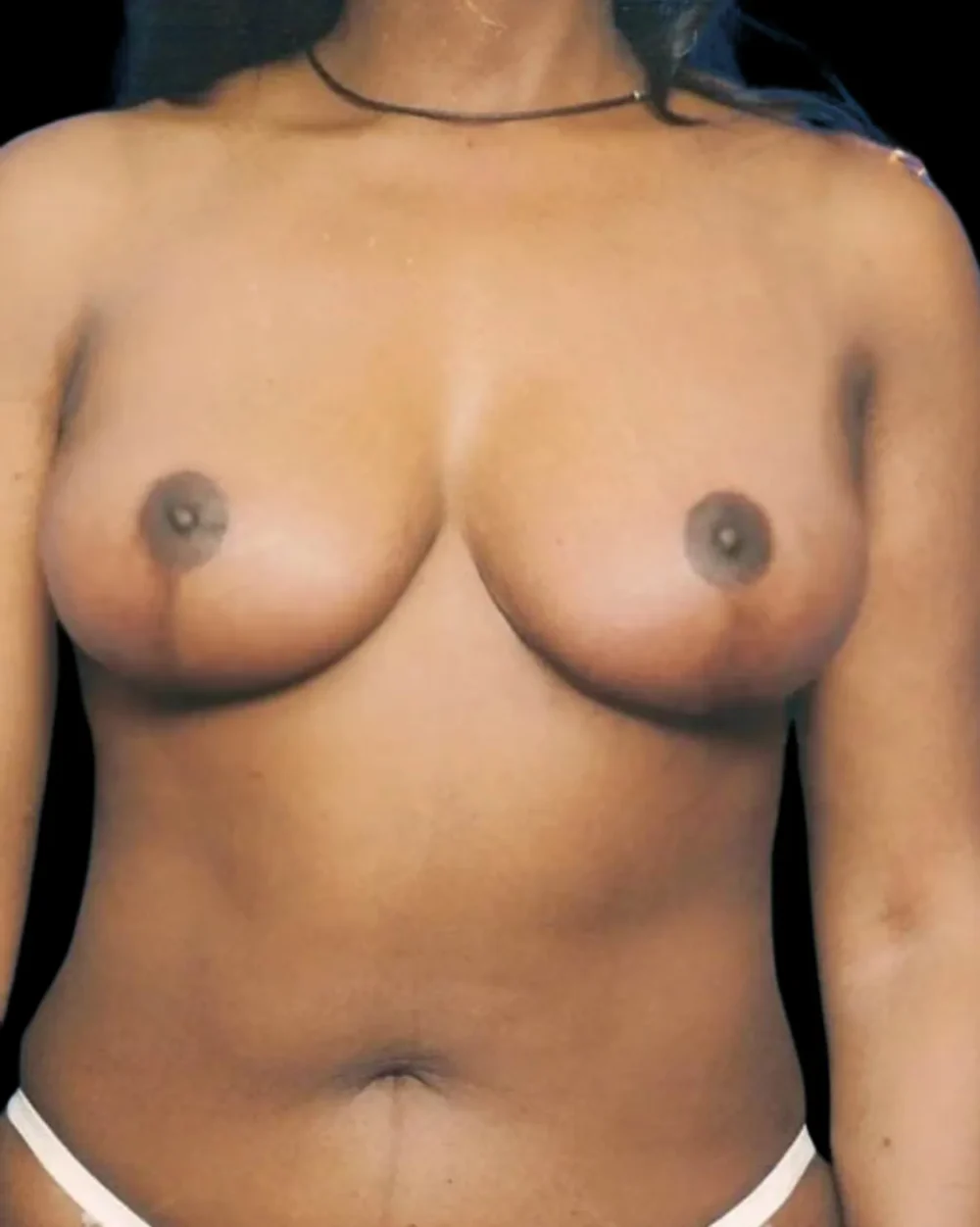 Breast Lift case #3990