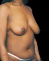 Breast Lift case #3990