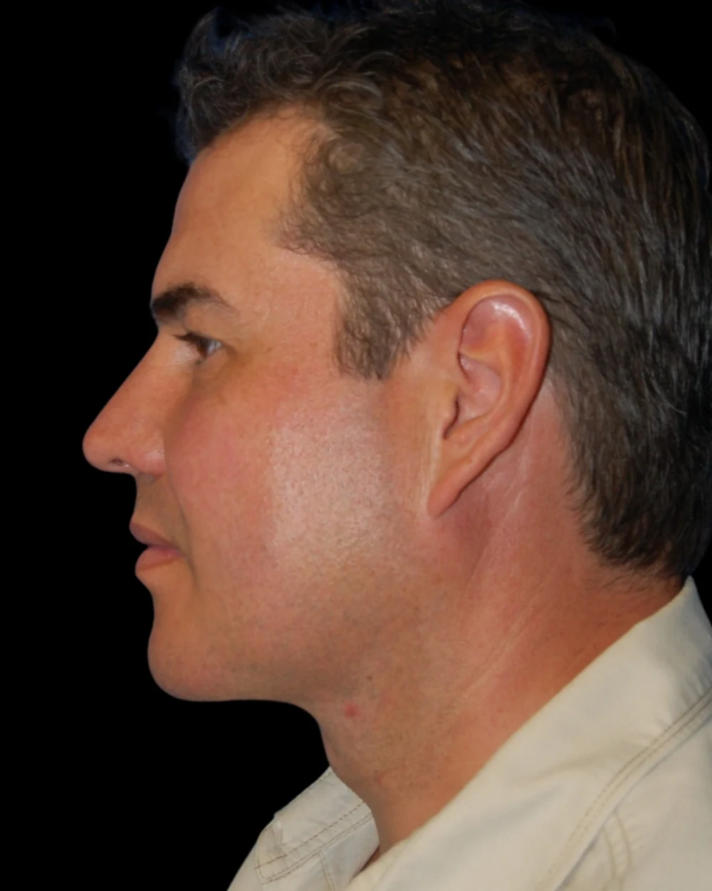 Neck Lift case #4857
