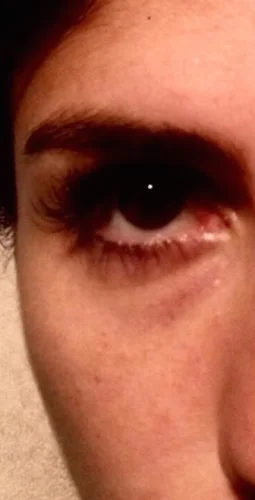 Dermal Fillers case #4348