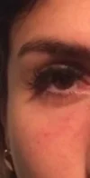 Dermal Fillers case #4348