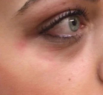 Dermal Fillers case #4357
