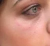 Dermal Fillers case #4357