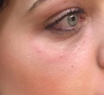Dermal Fillers case #4357