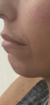 Dermal Fillers case #4351