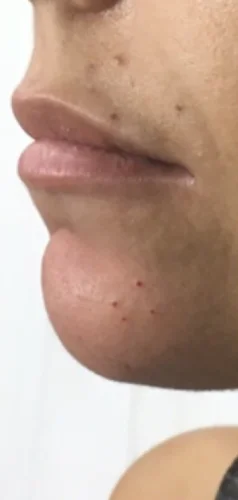 Dermal Fillers case #4351