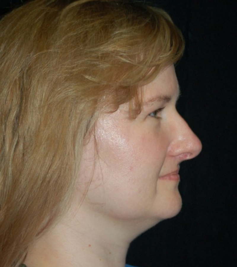 Brow Lift case #4071