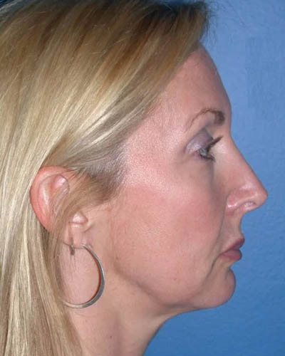 Facelift case #4369