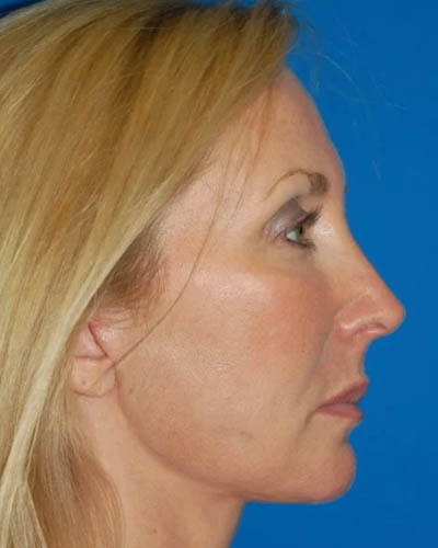 Facelift case #4369