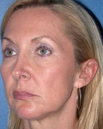 Facelift case #4369