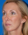 Facelift case #4369