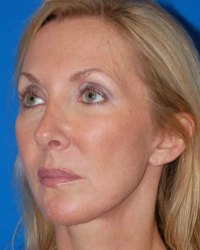 Facelift case #4369