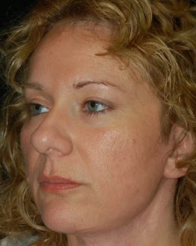 Facelift case #4376