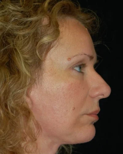Facelift case #4376