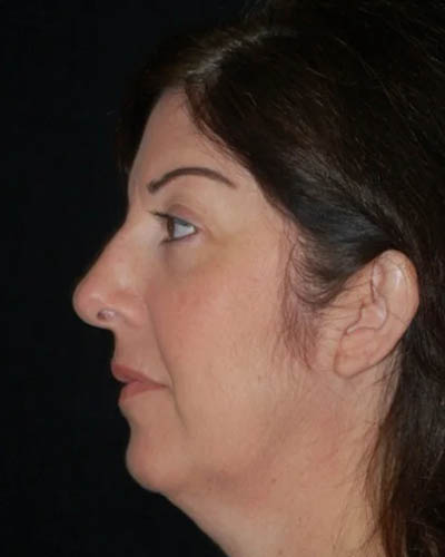 Facelift case #4381