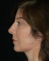 Facelift case #4381