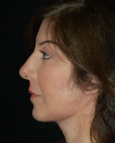 Facelift case #4381