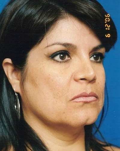 Facelift case #4388