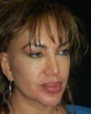 Facelift case #4395