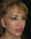 Facelift case #4395