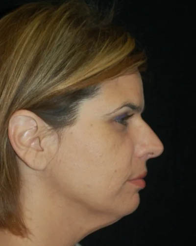 Facelift case #4403