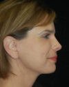 Facelift case #4403