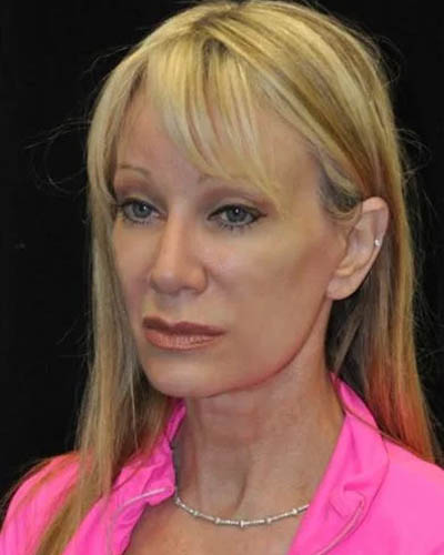 Facelift case #4410