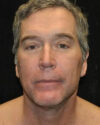 Facelift case #4417
