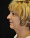 Facelift case #4422
