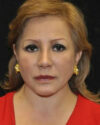 Facelift case #4467
